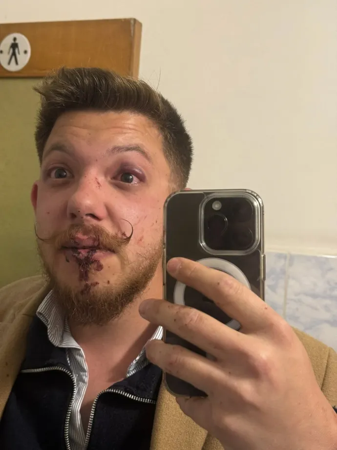 Béres Norbert, az egyik bántalmazott fiatal a húsvéthétfőn történt incidens után – Fotó: Béres Norbert Facebook