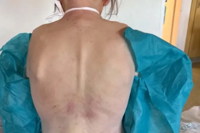 Ápolók bántalmazhattak egy mozgáskorlátozott beteget a Jahn Ferenc Dél-pesti Kórházban, a rendőrség nyomoz